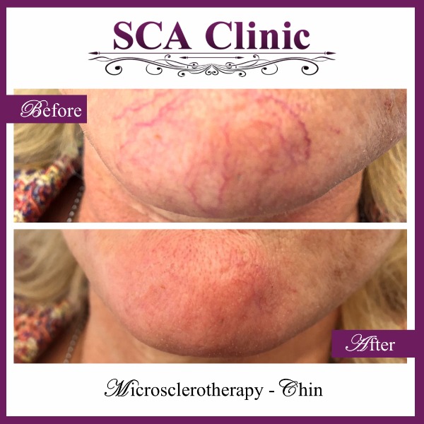 Microsclerotherapy - Chin